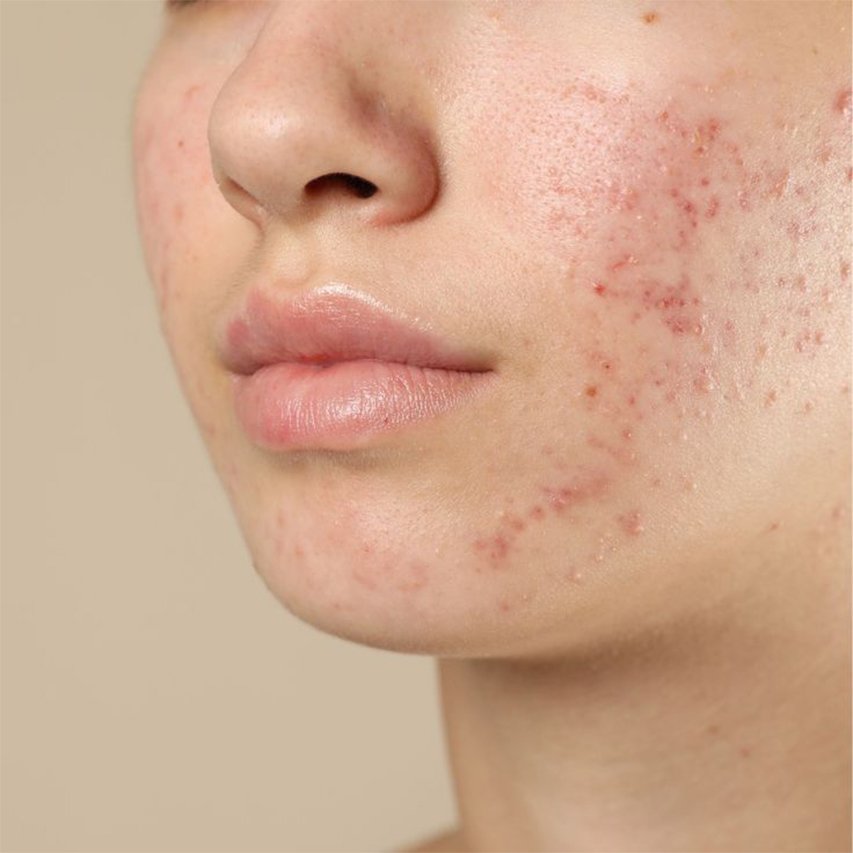 acne & blemish treatment in trivandrum